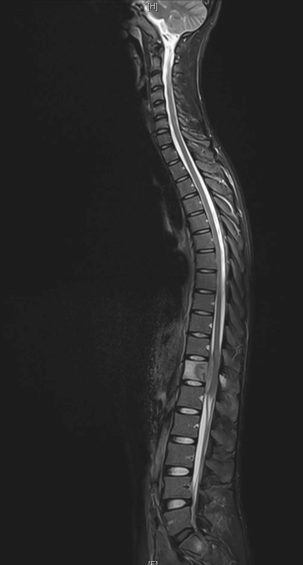 Lumbar spine MRI sequence T2 revealing spondylitis involving T12 